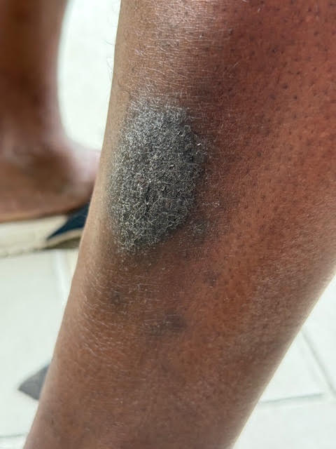 5 Eczema Triggers and How a Body Cream for Eczema Can Help