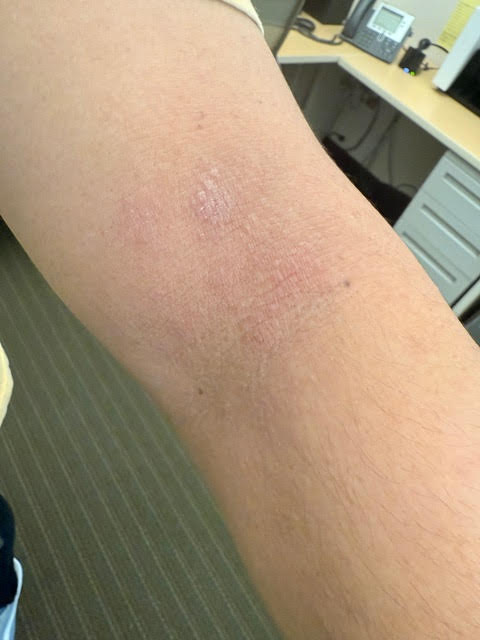 Why Steroid-Free Body Cream is Better for Sensitive Skin Healing