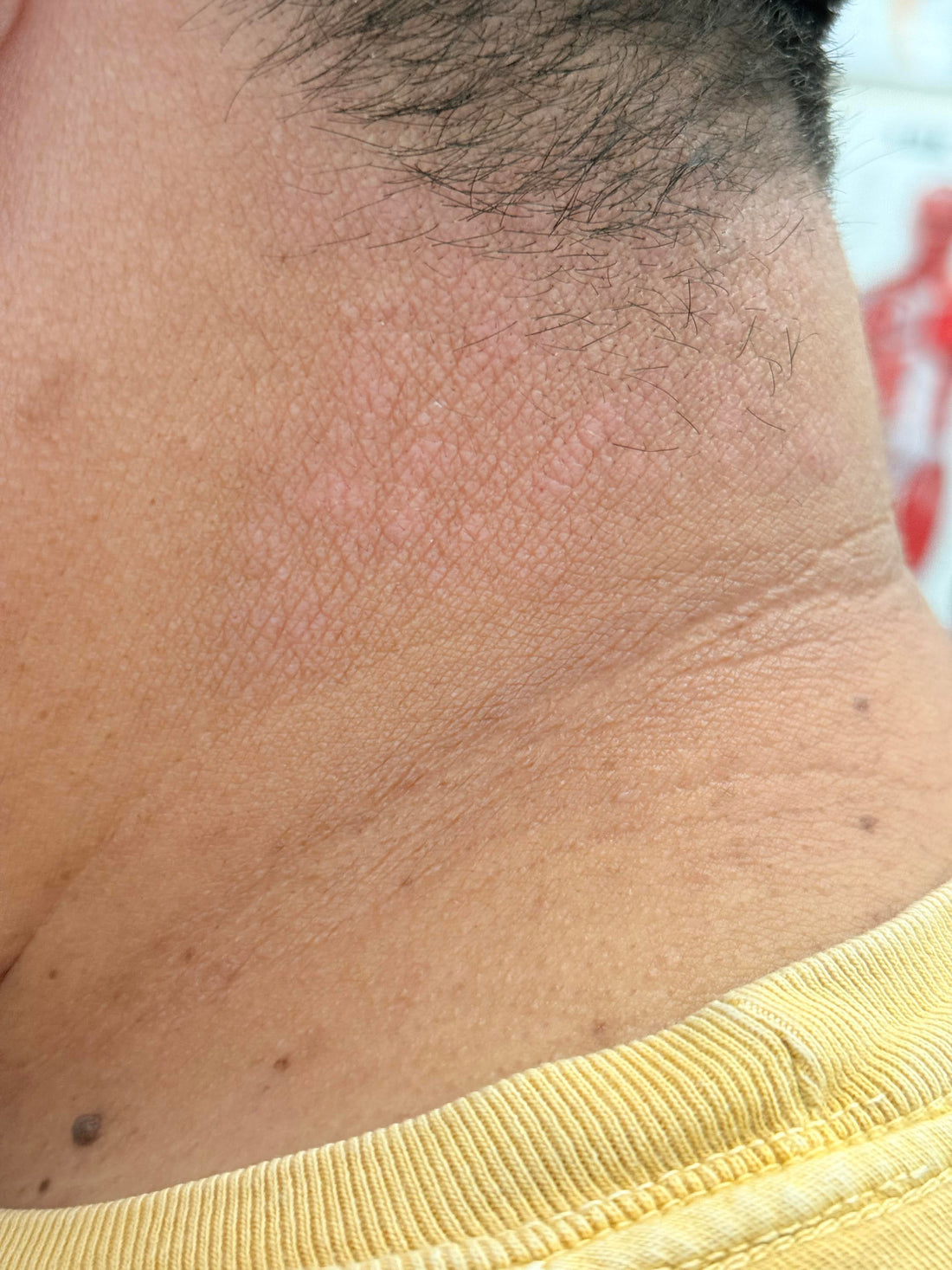 How To Choose a Safe Body Cream for Eczema and Psoriasis?