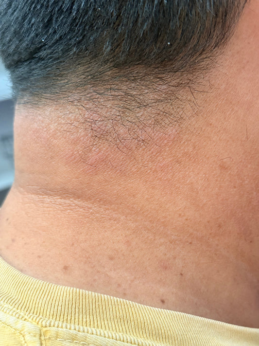 How a Gentle Soothing Cream Helps with Rosacea